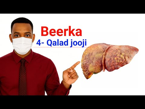 Dufanka Beerka Fuula Fatty Liver Disease 4 Sabab Iyo Xalka Ugu Fudud
