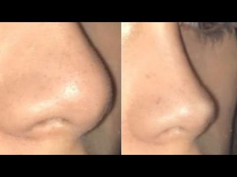 Experimental Nose Tip Reduction