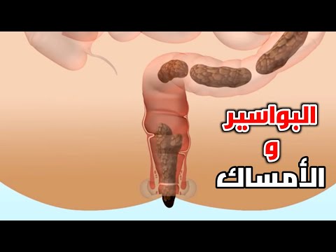 شاهد كيف تحدث البواسير How Do Hemorrhoids Occur