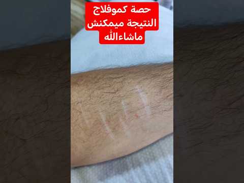 إختفء الندبات بحصة كموفلاج مشاء الله اللهم بارك Music إزالة الكلف Tattoo ازالة التجاعيد المغرب