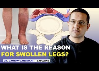 Swollen Feet Ankle Swelling Leg Swelling May Thurner Syndrome Dr Gaurav Gangwani