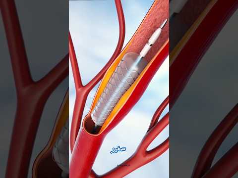 قسطرة القلب