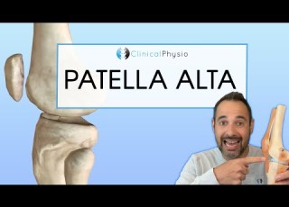 Patella Alta Expert Explains Diagnosis Assessment And Treatment