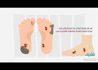 موشن جرافيك داء السكري
