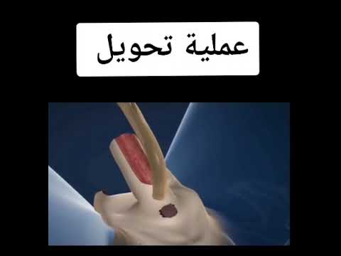 عملية تحويل مهند الرديني من ذكر ألى أنثى الفيديو لايناسب أصحاب القلوب الضعيفه عملية تحويل مهند الرديني من ذكر ألى أنثى الفيديو لايناسب أصحاب القلوب الضعيفه