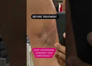 Dark Underarms Killing Your Confidence Dr Ashima Goel Dermatologist Chandigarh Mohali Shorts