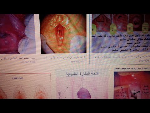 The Hymen Everything You Need To Know From A To Z Important Information For Women A Scientif