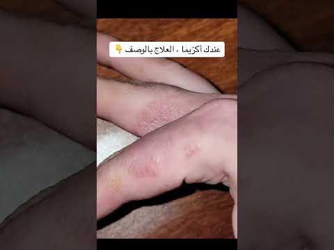 حبوب صغيرة مؤلمة على اليدين عند النساء