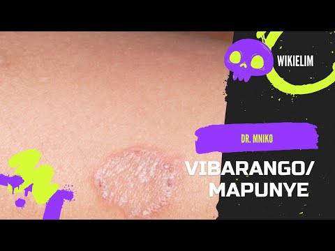 VIBARANGO MAPUNYE MASHILINGI Sababu Dalili Matibabu Na Nini Cha Kufanya