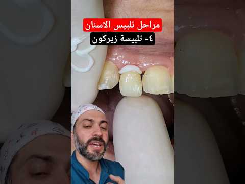 مراحل تلبيس الاسنان تلبيسات زيركون