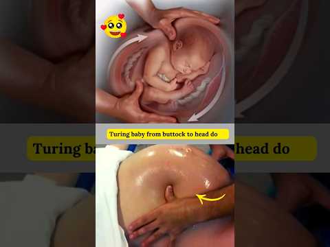 Turning Baby To Head Down Position Shortvideo Ecv