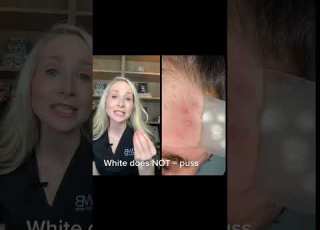  How Do Hydrocolloid Patches Work Dermatologist Explains Shorts