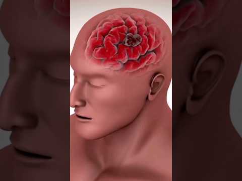ورم المخ Shorts