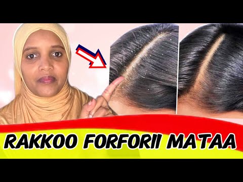 Rifeensa Forforiin Miidhamee Fi Furmaata Hatattamaa How To Get Rid Of Dandruff