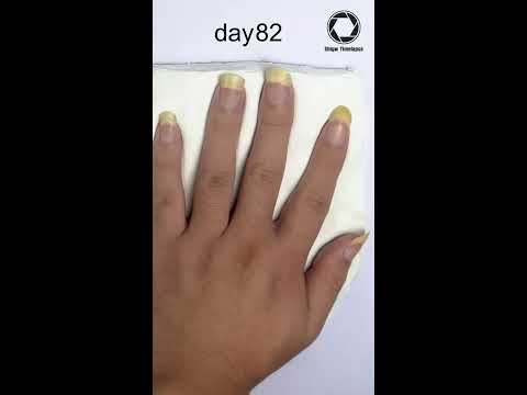 Fingernail Growing Time Lapse 90days Shorts Fingernail Growing Time Lapse 90days Shorts