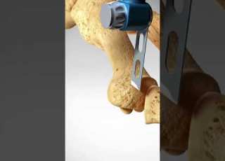  See How A Bunion Is Treated Bunionectomy With Osteotomy Toes Foot Feet
