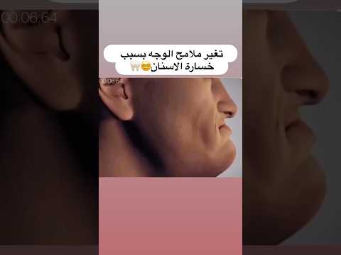 تأثير الاسنان على ملامح الوجه