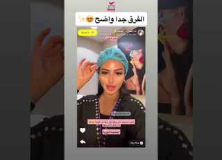 الشد الكوري للجميلة لما العقيل مع الدكتورة مروة رحاب بعيادة بيرل الازدهار عيادات بيرل الازدهار