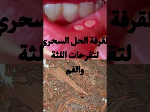 علاج تقرحات الفم واللثة وداعا الألم بالقرفة فقط علاج تقرحات الفم واللثة وداعا الألم بالقرفة فقط