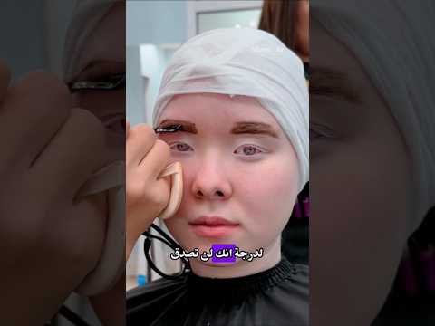 كانت هذه شابة مصابة بالمهق قصص قصص واقعية الشعب الصيني ماله حل مهق سخرية اكسبلور Fypシ