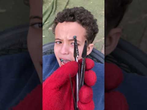 ازاله الحبايه المسرطنه