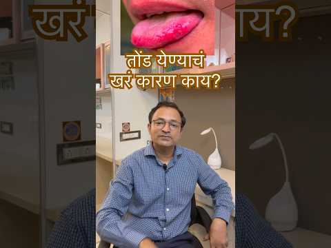 त ड क य त क रण व उप य Mouth Ulcer Ayurveda Health Tips