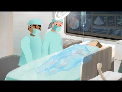What Is Catheter Ablation