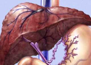 TIPSS Transjugular Intrahepatic Porto Systemic Shunt