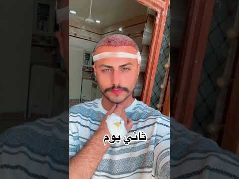قبل وبعد عملية زراعة الشعر في العراق قبل وبعد عملية زراعة الشعر في العراق