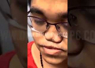  Nose Surgery In India A Rare Case Before And After Results Dr Mathew PC Shorts
