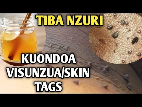 TIBA YA KUONDOA VISUNZUA SKIN TAGS KATIKA NGOZI SIKU 7 TU