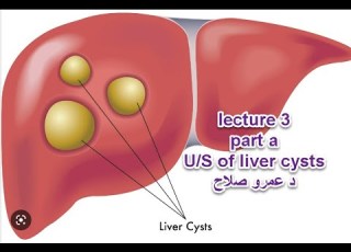  Abdominal U S Course Lecture 3 Part A Liver Cyst د عمرو صلاح