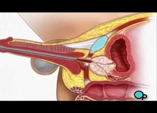  TURP Transurethral Resection Prostate Penis Surgery PreOp Patient Education