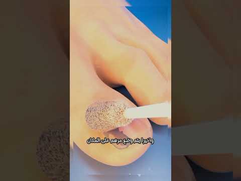 طريقة إزالة الظفر المتضرر بخطوات بسيطة وآمنة علاج فعال وسريع للتعافي الكامل إزالة الظفر