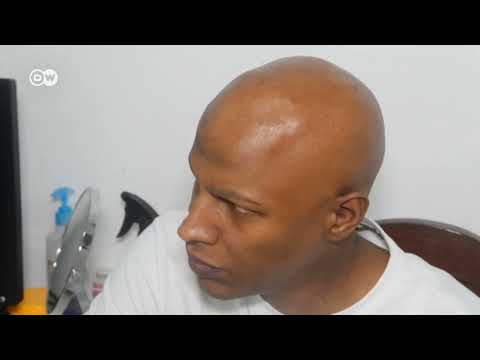 Kurunzi Afya Ugonjwa Wa Alopecia