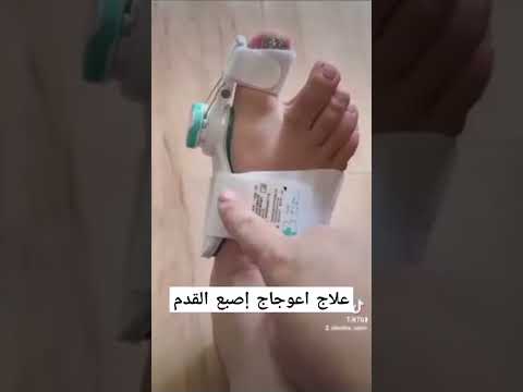 علاج إعوجاج إصبع القدم