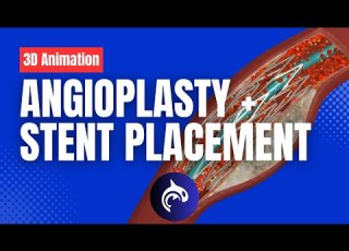 Angioplasty And Stent Placement 3D Animation