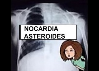  Nocardia Asteroides