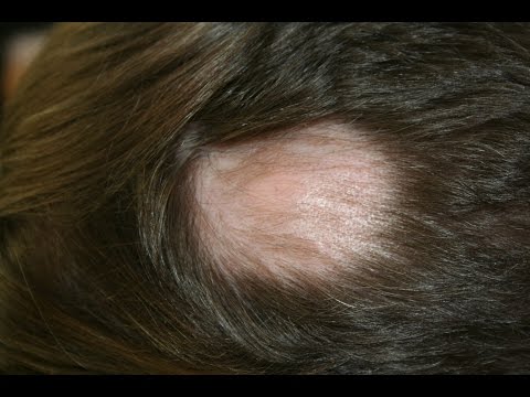 الثعلبة هل هي معدية