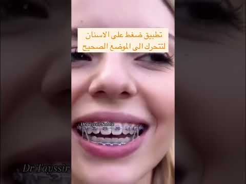 مطاط تقويم الاسنان