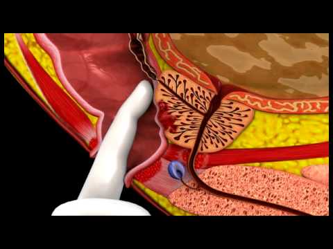 Prostate Cancer 3D Medical Animation ABP