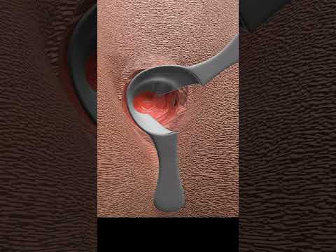 Warum Brauche Ich Eine Fisteloperation Shorts Fistel