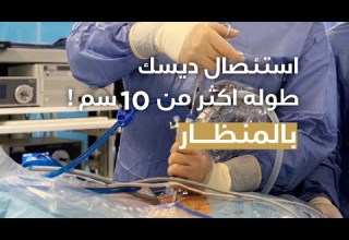 شرح تفصيلي لعملية ديسك كبير جدا بالمنظار