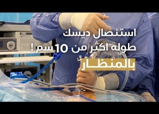 شرح تفصيلي لعملية ديسك كبير جدا بالمنظار