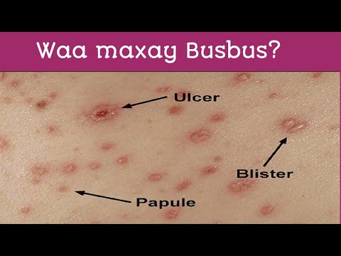 Cudurrada Ku Faafa Hawada 08 Busbuska Chickenpox Qeexitaanka Waxa Sababo Qaabka Uu U Faafo
