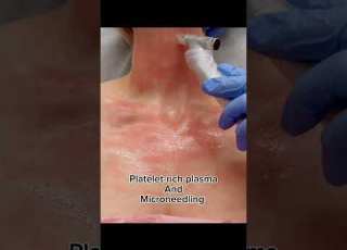 Tips For A Gorgeous Neck And Décolleté Neckrejuvenation