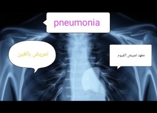  شرح محاضرة Pneumonia معهد تمريض الفيوم فرقه اولى ترم ثاني 2025