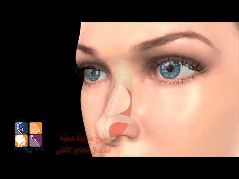 شاهد شرح طريقه عمليه الجيوب الانفيه دكتور محمود يوسف شاهد شرح طريقه عمليه الجيوب الانفيه دكتور محمود يوسف