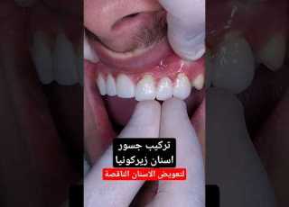  تركيب جسور اسنان زيركونيا