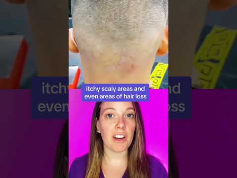 Fungal Infection Of Scalp Ringworm Tinea Capitis